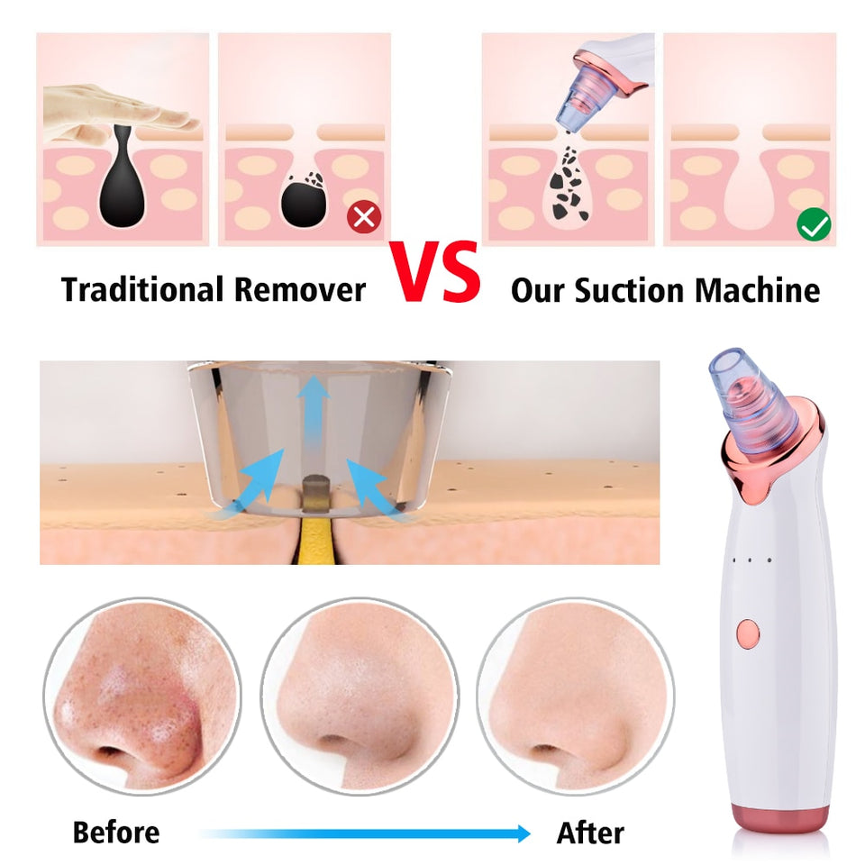 Wireless Blackhead Suction Cleaning Device